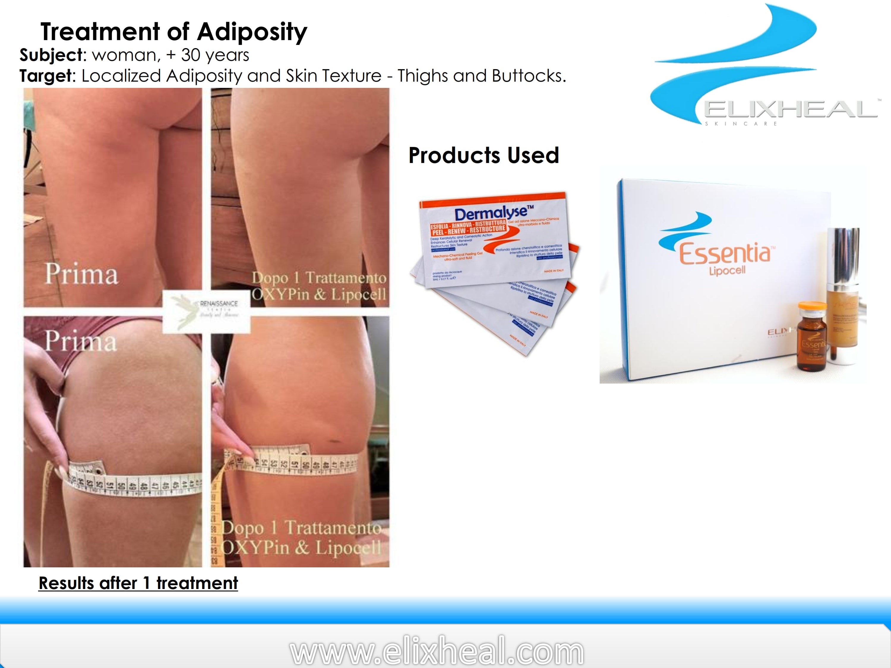 xcel lipo c Excel V Laser | Before & After Photos main image 1